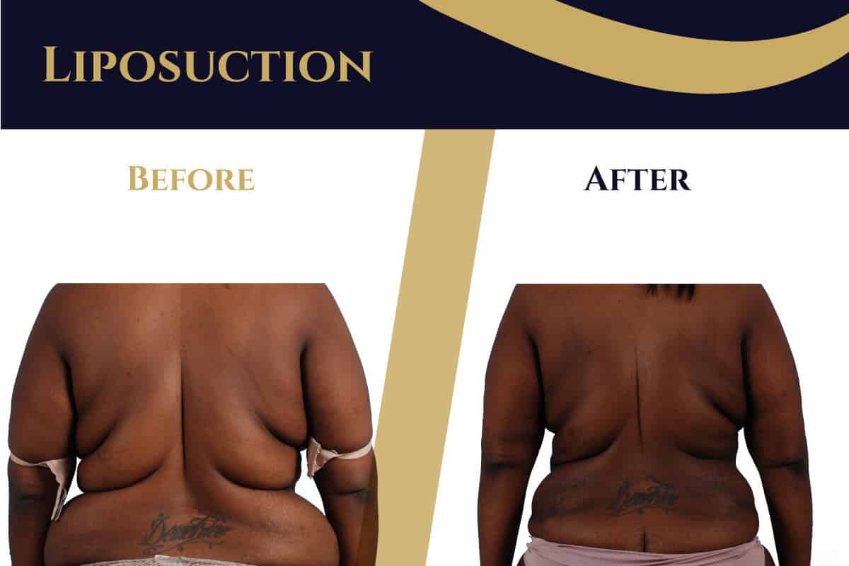 Liposuction in Atlanta, Lipo Procedure